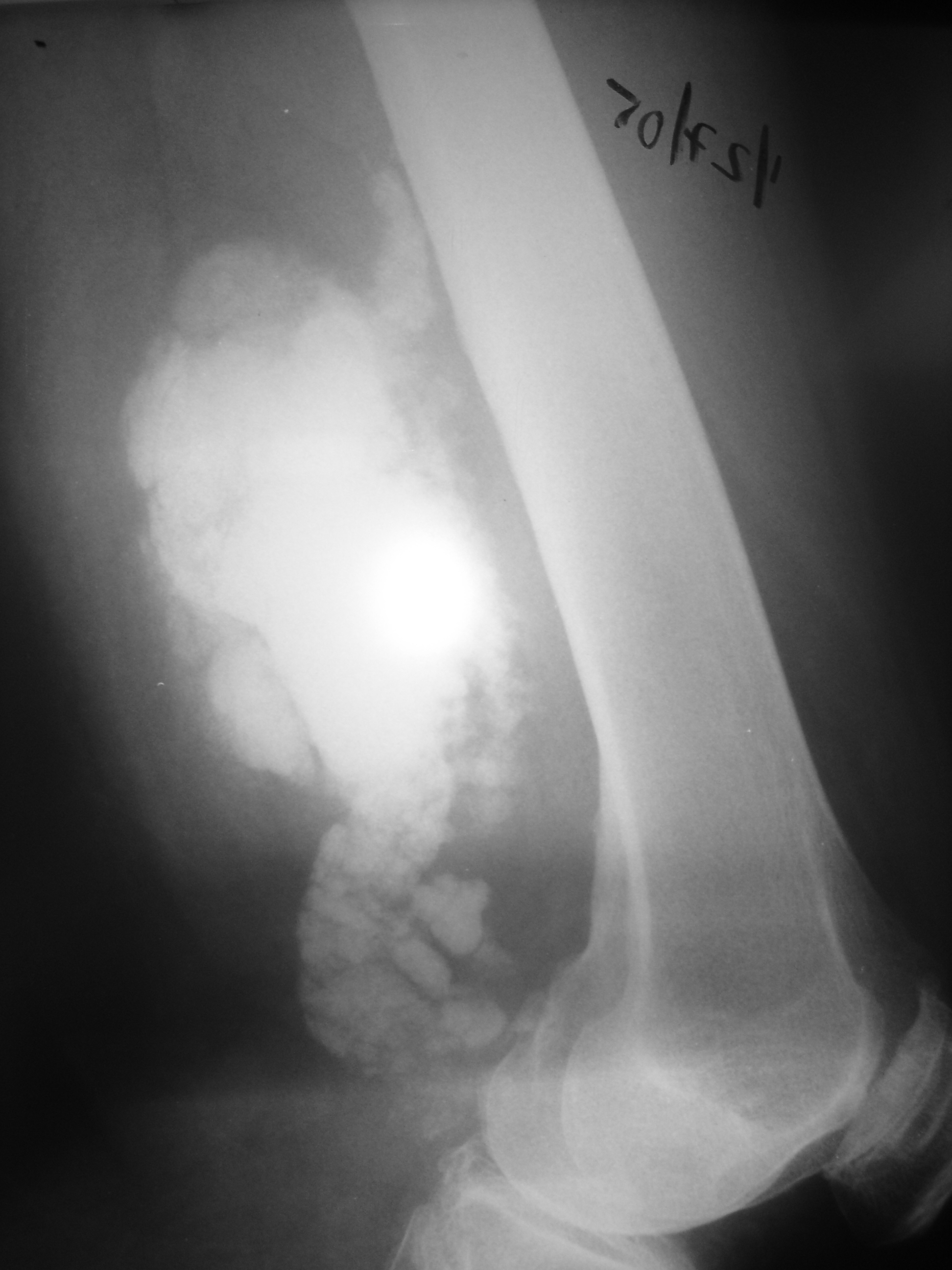 Extraskeletal Osteosarcoma Soft Tissue Osteosarcoma